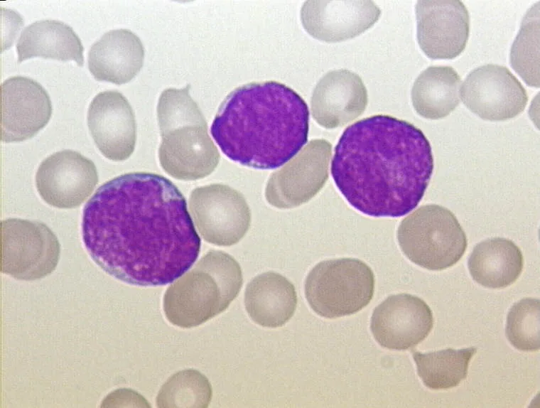 Acute lymphoblastic leukemia (ALL) – Blood smear of a child with ALL (Pappenheim stain): three large lymphoblasts among the red cells