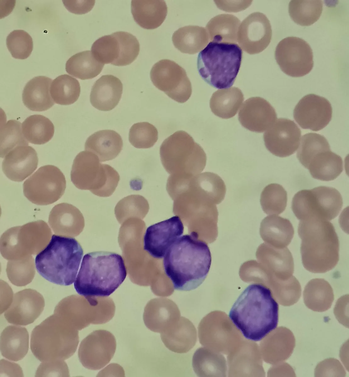 Acute lymphoblastic leukemia (ALL) – Peripheral blood smear in ALL: several lymphoblasts with fine chromatin and little cytoplasm