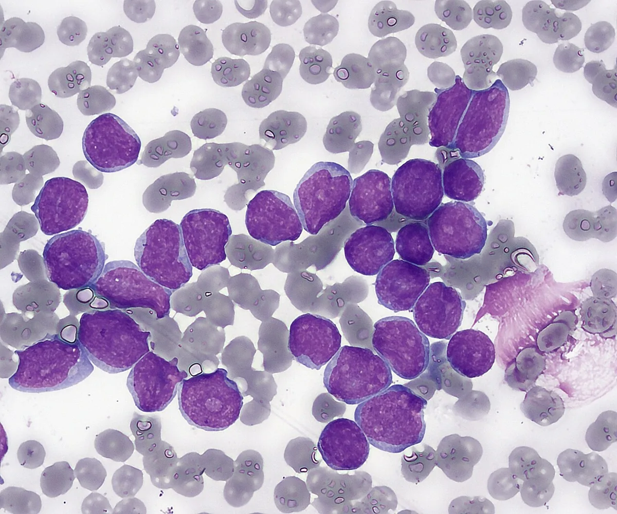 Acute lymphoblastic leukemia (ALL) – Bone marrow smear in ALL: densely packed lymphoblasts with a high nuclear-cytoplasmic ratio and scant basophilic cytoplasm