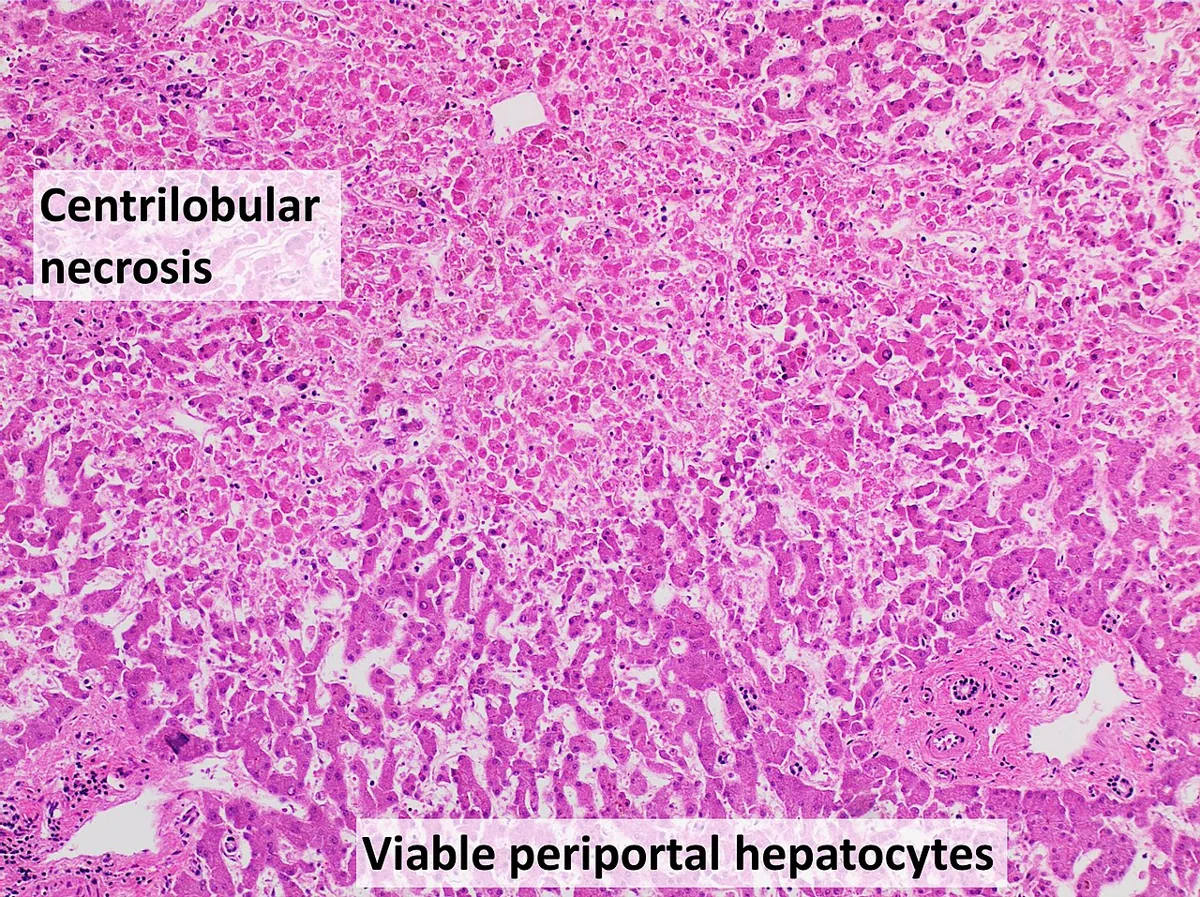 Acute liver failure – Histology (H&E, labelled): shock liver with centrilobular necrosis and viable periportal hepatocytes