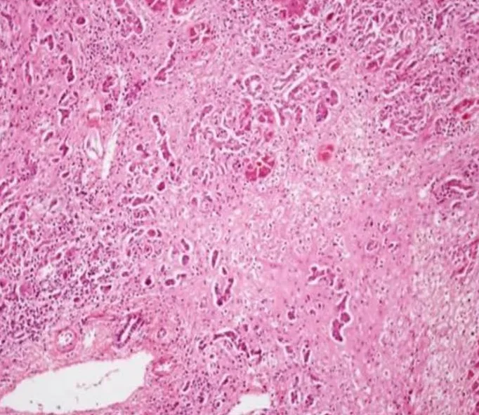 Acute liver failure – Histology (H&E): massive hepatic necrosis in hepatitis B – loss of liver cells with only scattered residual hepatocytes, portal tracts still intact