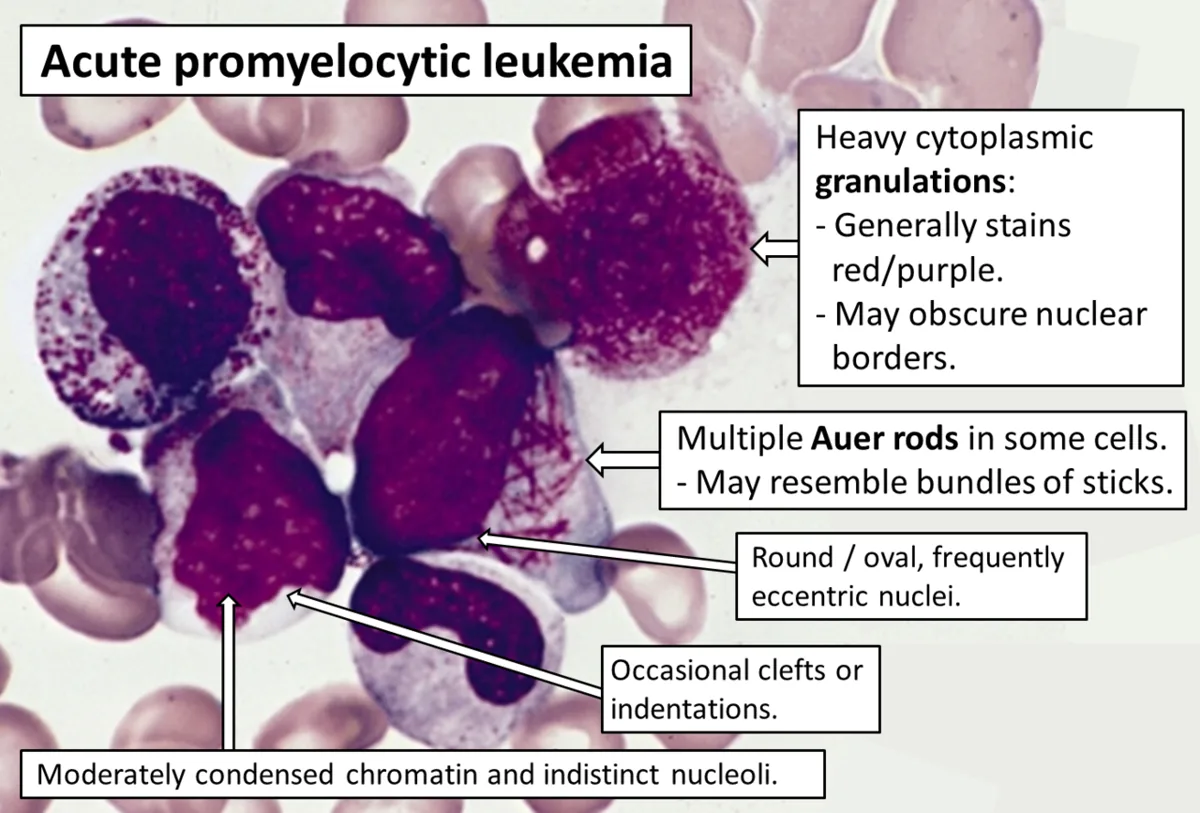 Acute myeloid leukemia (AML) – blood smear/cytology: Acute promyelocytic leukemia (annotated): abnormal promyelocytes with heavy granulation and bundled Auer rods