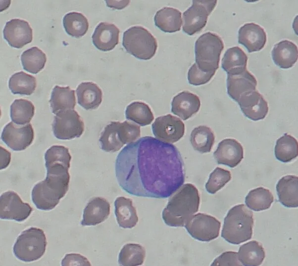 Acute myeloid leukemia (AML) – Blood smear: myeloblast with a needle-shaped, reddish Auer rod in the cytoplasm