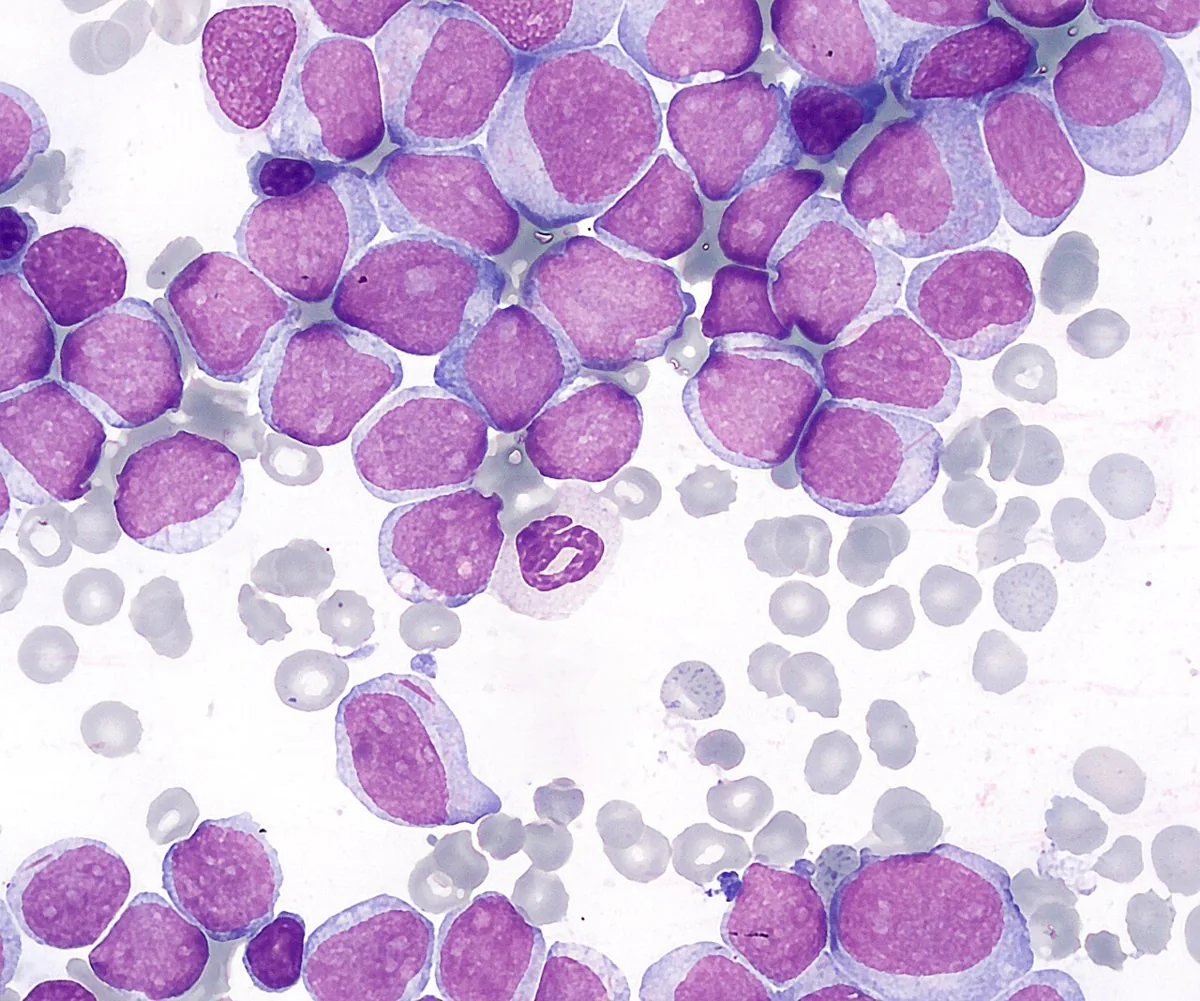 Acute myeloid leukemia (AML) – Smear in AML: densely packed large myeloblasts with fine chromatin, nucleoli and narrow, partly granular cytoplasm