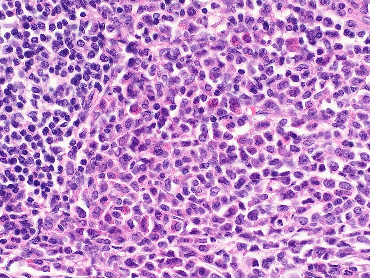 Acute myeloid leukemia (AML) – Histology: myeloid sarcoma (extramedullary AML) in a lymph node – sheets of immature myeloid cells beside small lymphocytes