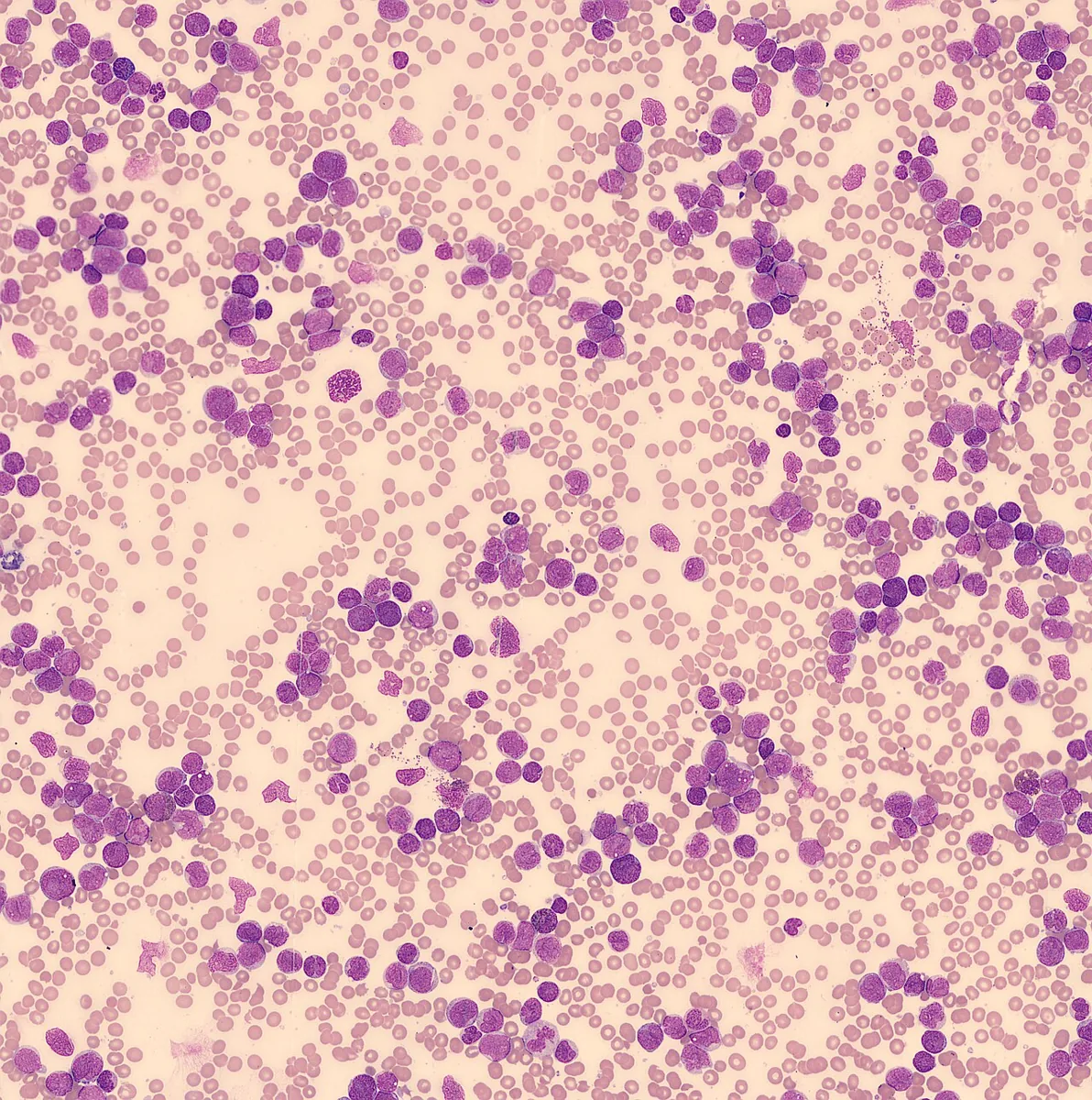 Acute myeloid leukemia (AML) – Peripheral blood smear in AML (overview): masses of blasts between the red cells