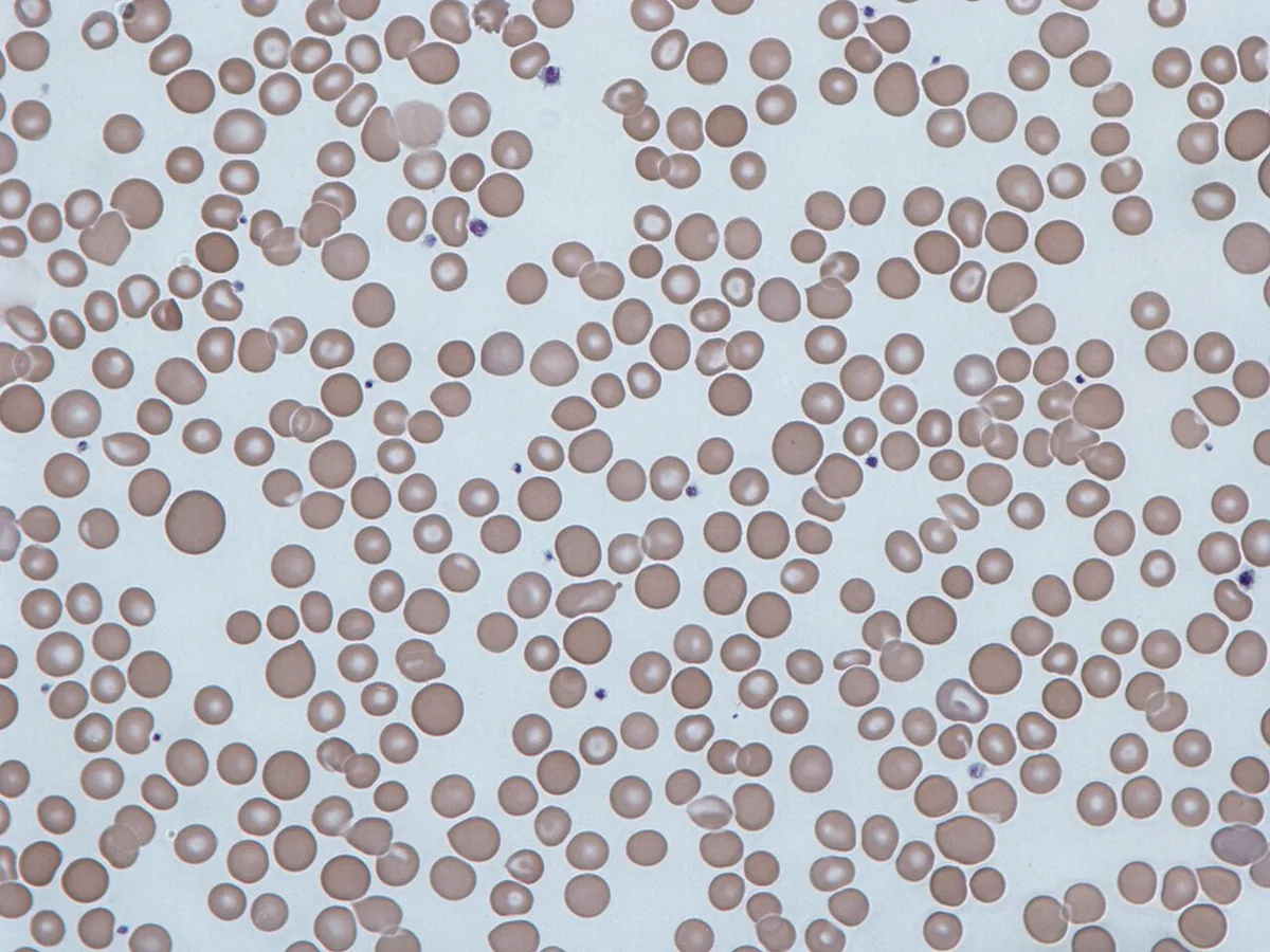 Anämie (Einteilung und Abklärung, Blutarmut) – Blutausstrich mit Anisozytose: Erythrozyten deutlich unterschiedlicher Größe nebeneinander