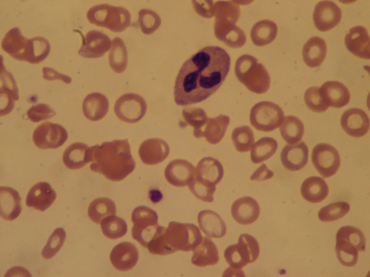 Anämie (Einteilung und Abklärung, Blutarmut) – Blutausstrich bei Anämie: blasse, unterschiedlich große Erythrozyten (Anisozytose, Hypochromie) neben einem Granulozyten