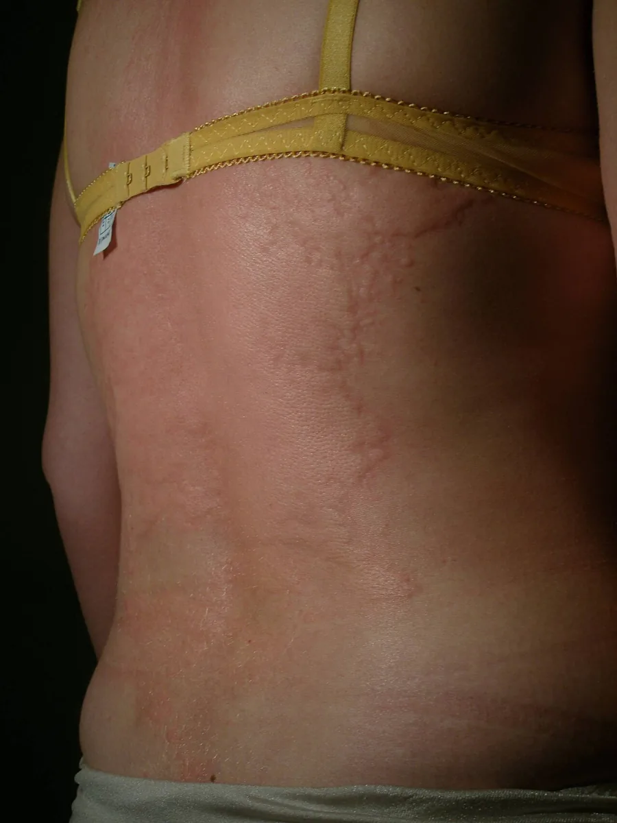 Anaphylaxis – whole body – clinical photo: Extensive, confluent wheals on the back – generalised urticaria, the most common skin sign of anaphylaxis