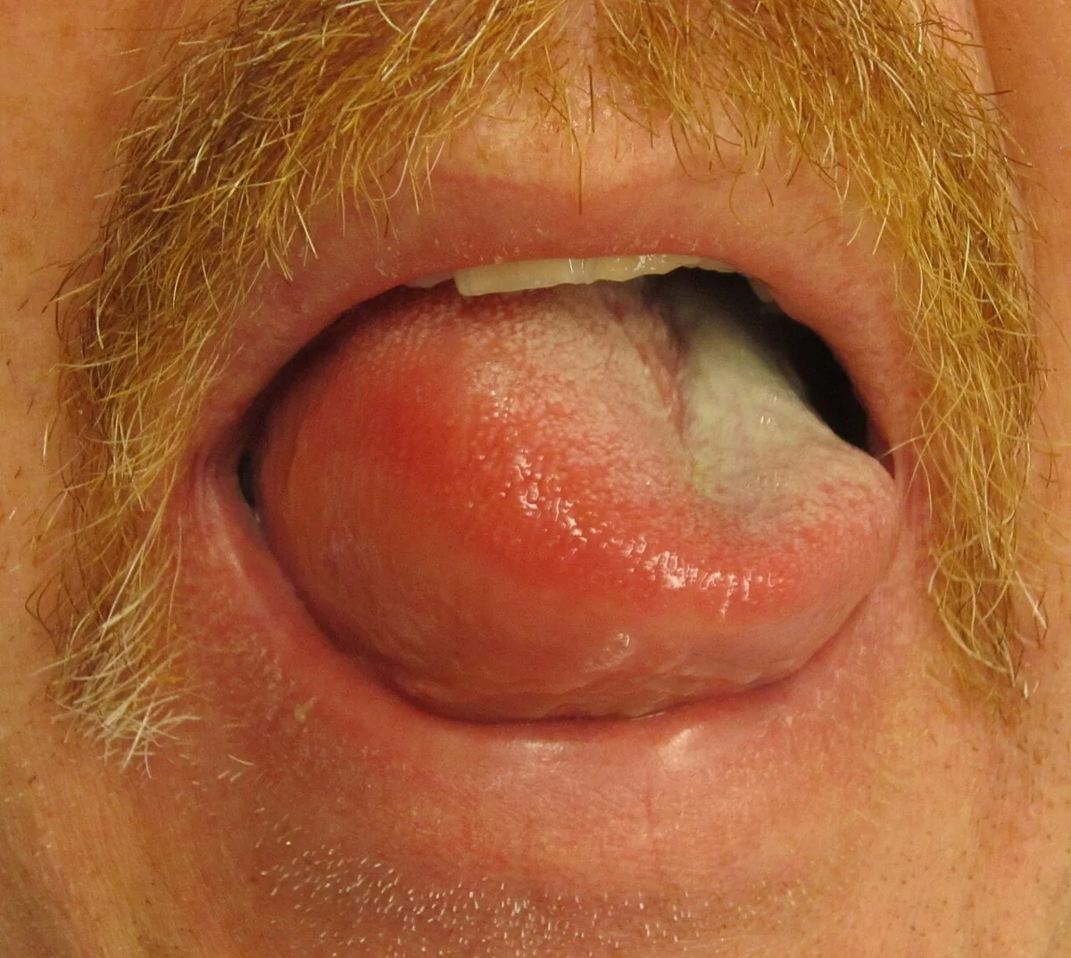 Angiedema (bradykinin- and histamine-mediated) – clinical photo: Angiedema of the tongue: massively swollen, reddened tongue filling the mouth opening