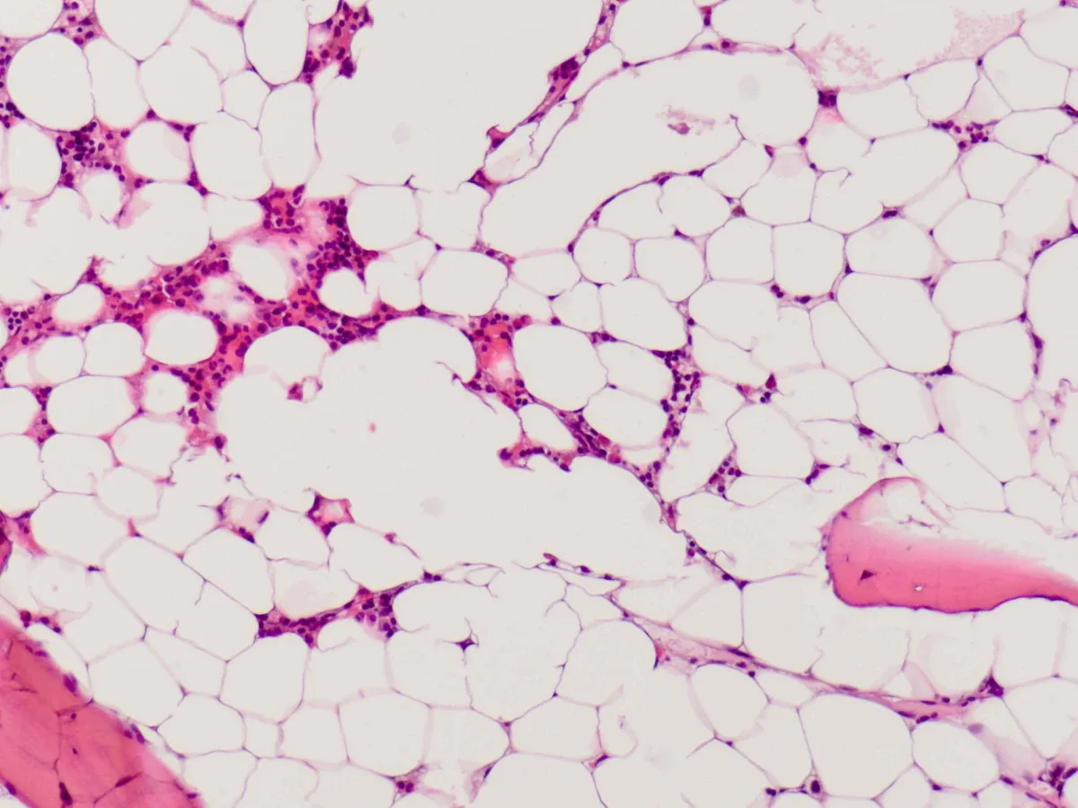 Aplastic anemia – histology: Bone marrow biopsy in aplastic anemia: markedly hypocellular marrow, mostly fat cells with only a few islands of hematopoiesis