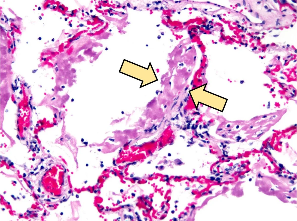 Acute respiratory distress syndrome (ARDS) – Histology (H&E): diffuse alveolar damage with eosinophilic hyaline membranes lining the alveolar walls (arrows)