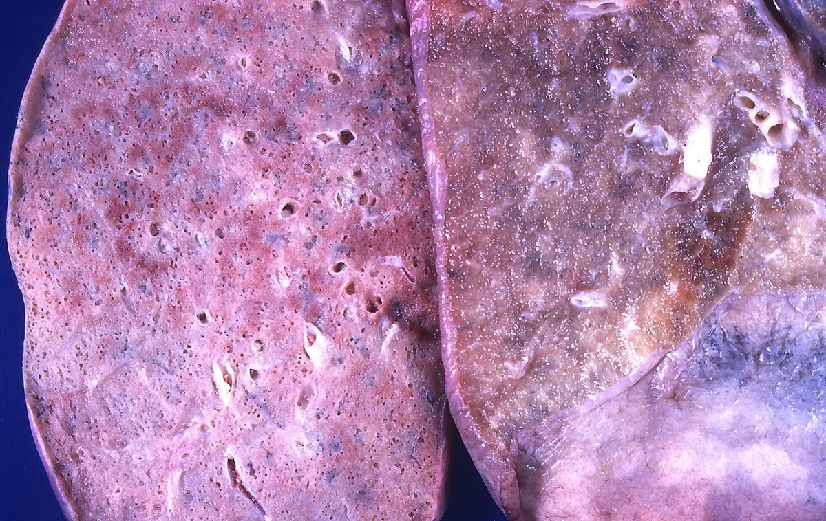 Acute respiratory distress syndrome (ARDS) – Gross specimen: left, a diffusely consolidated, pale, heavy lung in diffuse alveolar damage; right, a normal lung for comparison