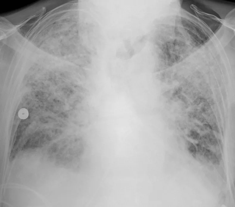 Acute respiratory distress syndrome (ARDS) – Chest X-ray (AP): ARDS with bilateral diffuse, patchy-to-confluent opacities and a normal-sized heart
