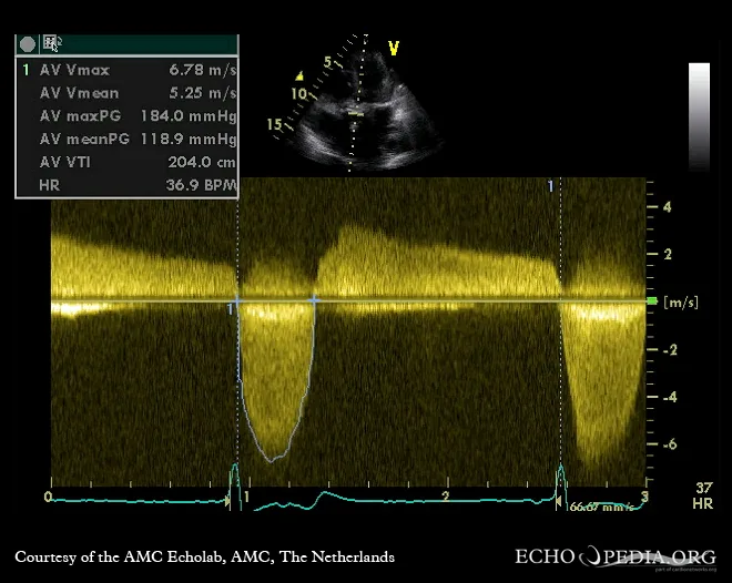 Aortic valve stenosis – Continuous-wave Doppler across the aortic valve: markedly increased velocity (Vmax 6.8 m/s, mean gradient 119 mmHg) in severe aortic stenosis