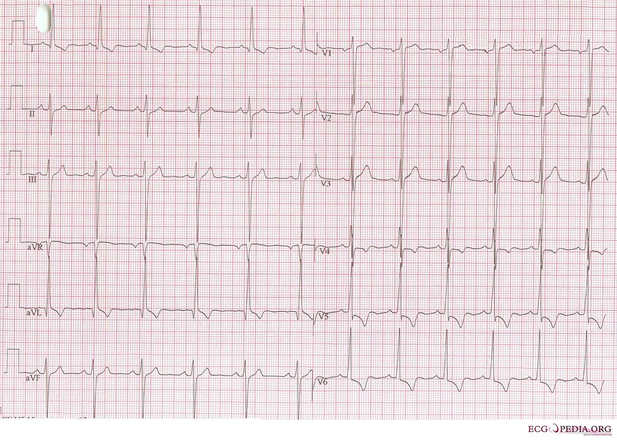 Aortic valve stenosis – 12-lead ECG: marked left ventricular hypertrophy with very high QRS voltages and ST-T changes in severe aortic stenosis