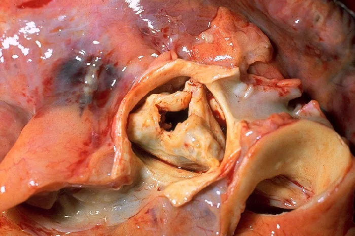 Aortic valve stenosis – gross specimen: Autopsy specimen: thickened, fused and calcified aortic cusps with a slit-like narrowed orifice (rheumatic origin)