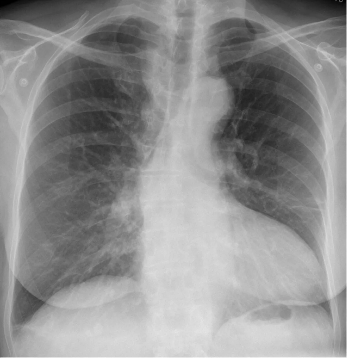 Aortic valve stenosis – Chest X-ray PA: aortic heart configuration with a prominent, rounded left ventricle and a prominent ascending aorta