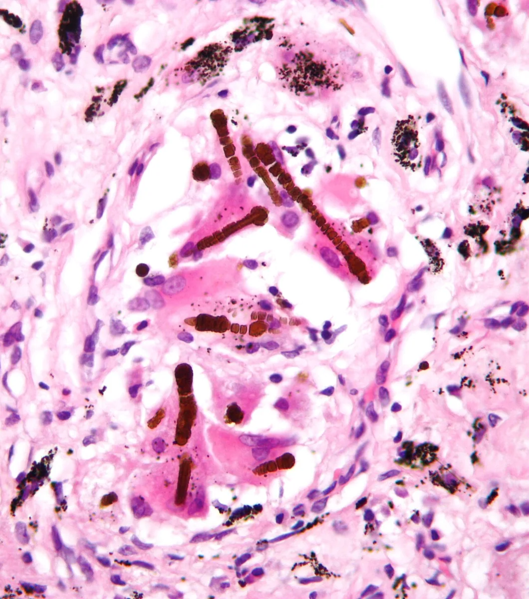 Asbestosis and pleural mesothelioma – Histology (H&E) in asbestosis: rust-brown, segmented, rod-shaped asbestos (ferruginous) bodies in fibrotic lung tissue