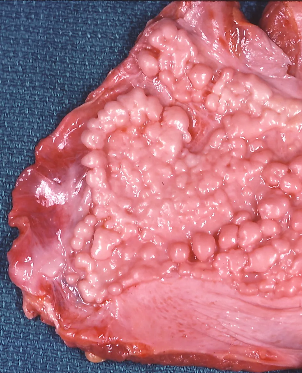 Asbestosis and pleural mesothelioma – Gross specimen: hyaline pleural plaque on the diaphragmatic pleura with a whitish, nodular (verrucous) surface
