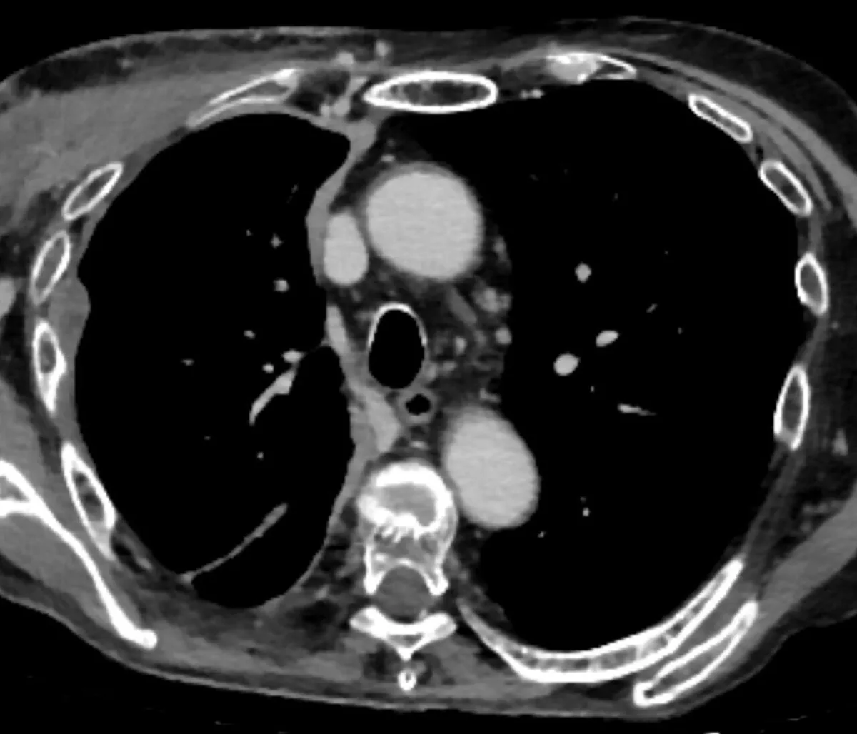 Asbestosis and pleural mesothelioma – Axial CT: right pleural mesothelioma with rind-like, nodular pleural thickening and volume loss of the affected hemithorax