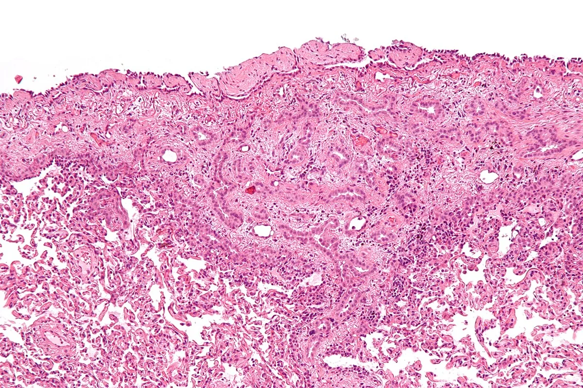 Asbestosis and pleural mesothelioma – Histology (H&E): epithelioid malignant pleural mesothelioma with clusters of tumor cells in the thickened pleura