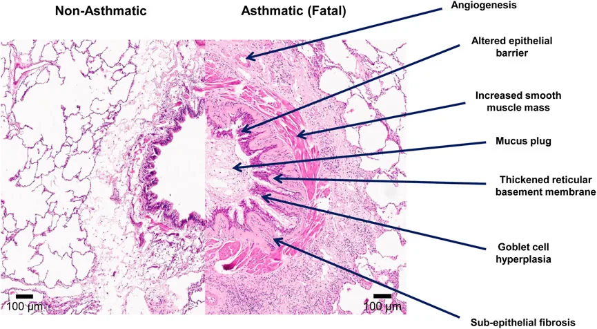Asthma – Histology comparison (labelled): normal airway vs. asthma with mucus plug, goblet cell hyperplasia, increased smooth muscle and subepithelial fibrosis