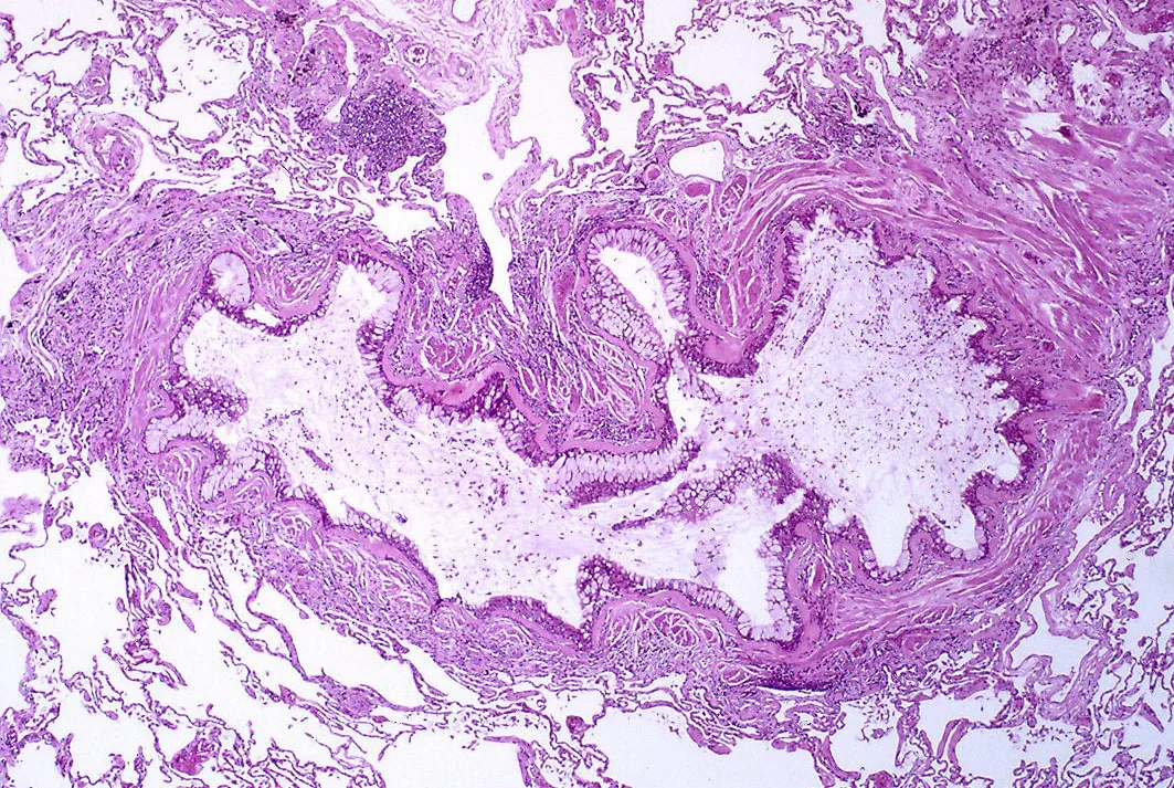 Asthma – Histology (H&E): bronchiole occluded by a mucus plug, goblet cell metaplasia, thickened basement membrane and dense mural inflammation
