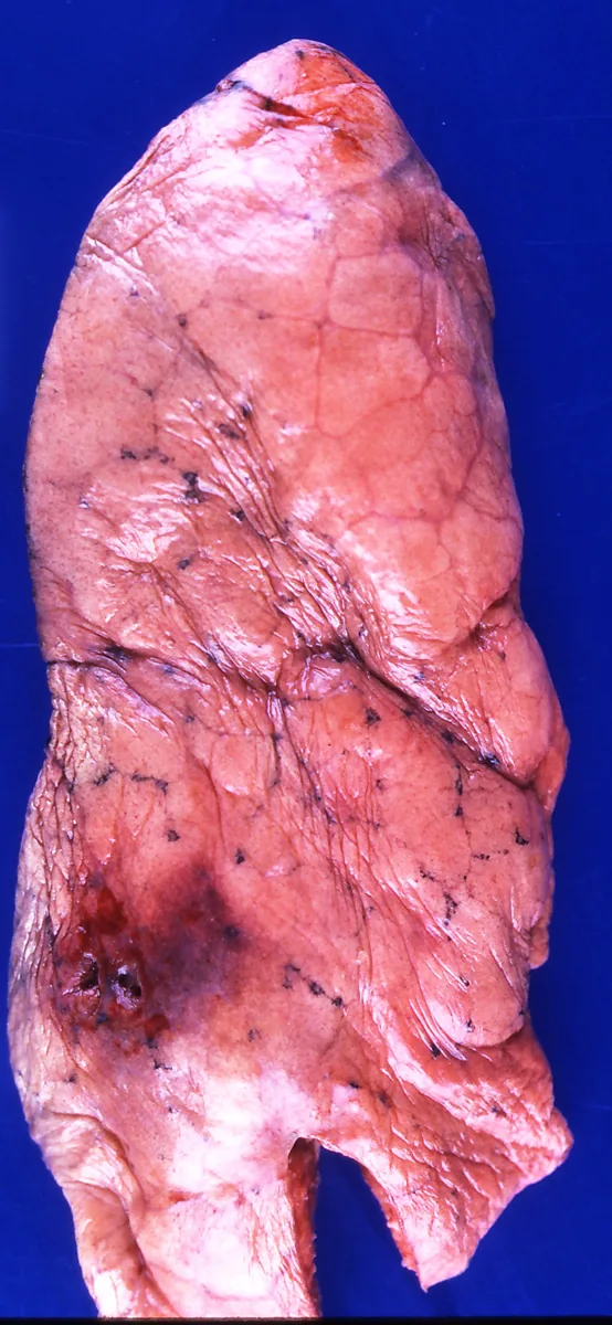 Asthma – Gross specimen: markedly hyperinflated, pale lung after fatal status asthmaticus