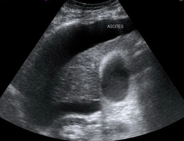 Ascites – Ultrasound: cirrhotic liver surrounded by anechoic ascites (labelled)