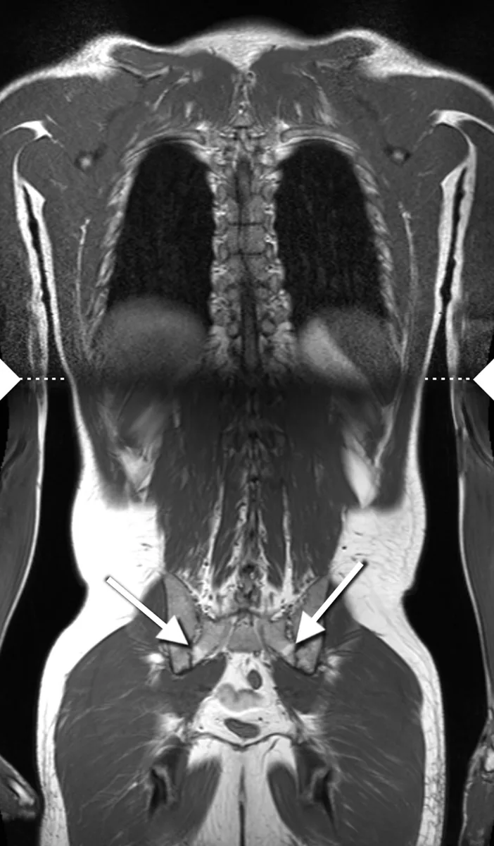 Axial spondyloarthritis (ankylosing spondylitis) – Whole-body MRI (coronal): bilateral sacroiliitis with changes at the sacroiliac joints (arrows)