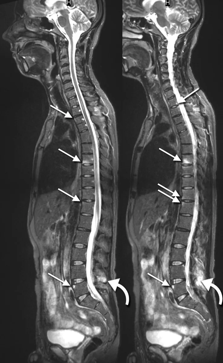 Axial spondyloarthritis (ankylosing spondylitis) – Spine MRI (sagittal, STIR): inflammatory high signal at several vertebral corners (spondylitis, arrows)