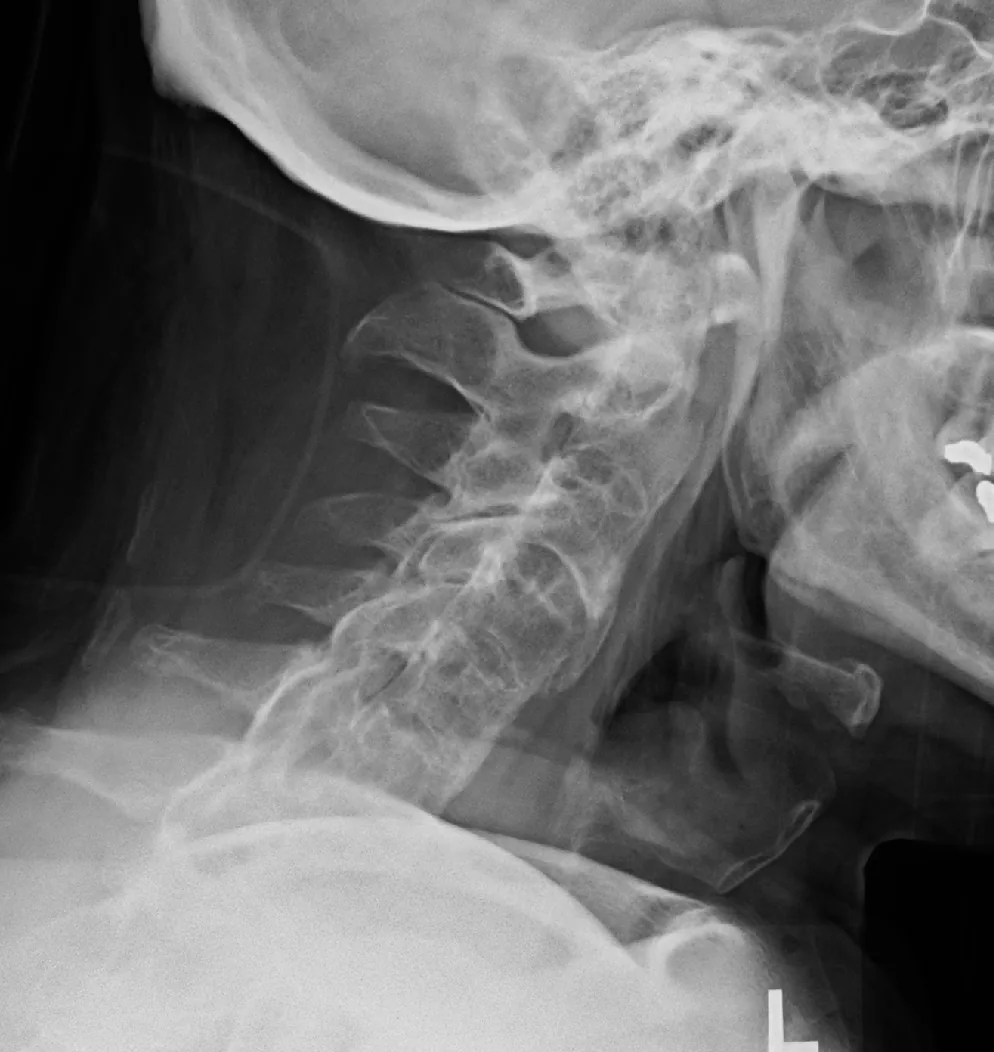 Axial spondyloarthritis (ankylosing spondylitis) – Lateral cervical spine X-ray: bony fusion between the vertebral bodies and ankylosis of the facet joints