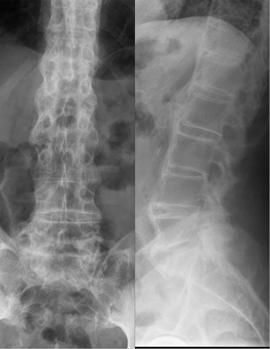 Axial spondyloarthritis (ankylosing spondylitis) – Lumbar spine X-ray (AP and lateral): slender calcified syndesmophytes spanning the disc spaces laterally and anteriorly