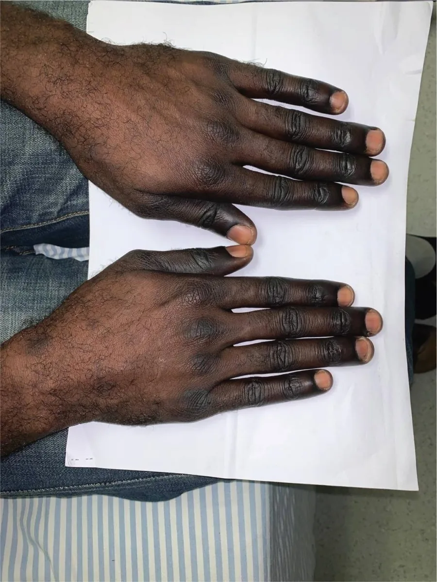 Vitamin B12 deficiency and pernicious anemia – clinical photo: Hands in pernicious anemia: dark hyperpigmentation over the knuckles and fingertips