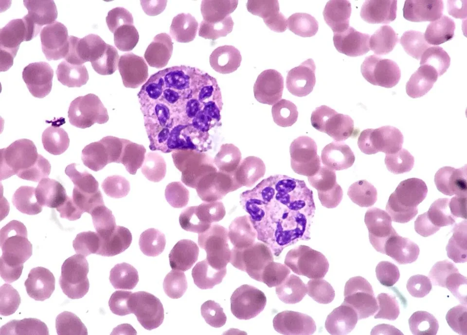 Vitamin B12 deficiency and pernicious anemia – Blood smear: hypersegmented neutrophils (6 or more nuclear lobes) and large red cells (macrocytosis)