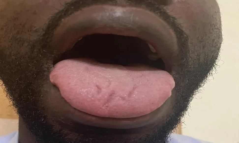 Vitamin B12 deficiency and pernicious anemia – mouth – clinical photo: Tongue in pernicious anemia: pale, smooth surface with loss of papillae and a few fissures (atrophic glossitis)