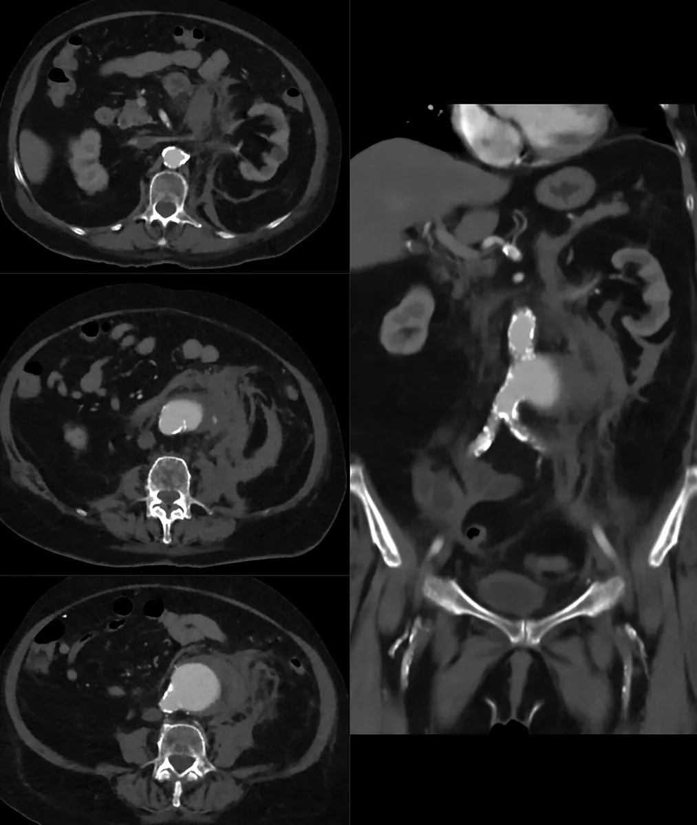 Abdominal aortic aneurysm – Axial and coronal CT: rupturing abdominal aortic aneurysm with an extensive left-sided retroperitoneal hematoma