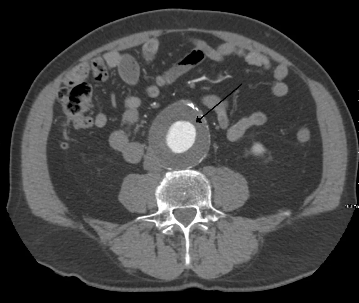 Abdominal aortic aneurysm – Contrast CT: infrarenal abdominal aortic aneurysm of about 6.5 cm with a thick mural thrombus and a residual lumen of only about 3 cm (arrow)