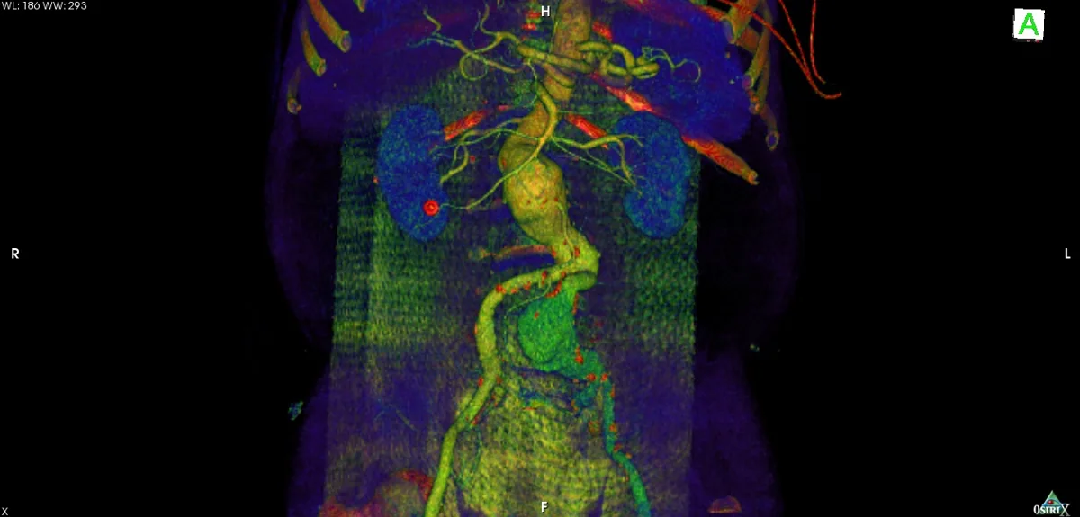 Abdominal aortic aneurysm – CT angiography, 3D reconstruction: infrarenal aortic aneurysm and a large aneurysm of the left common iliac artery