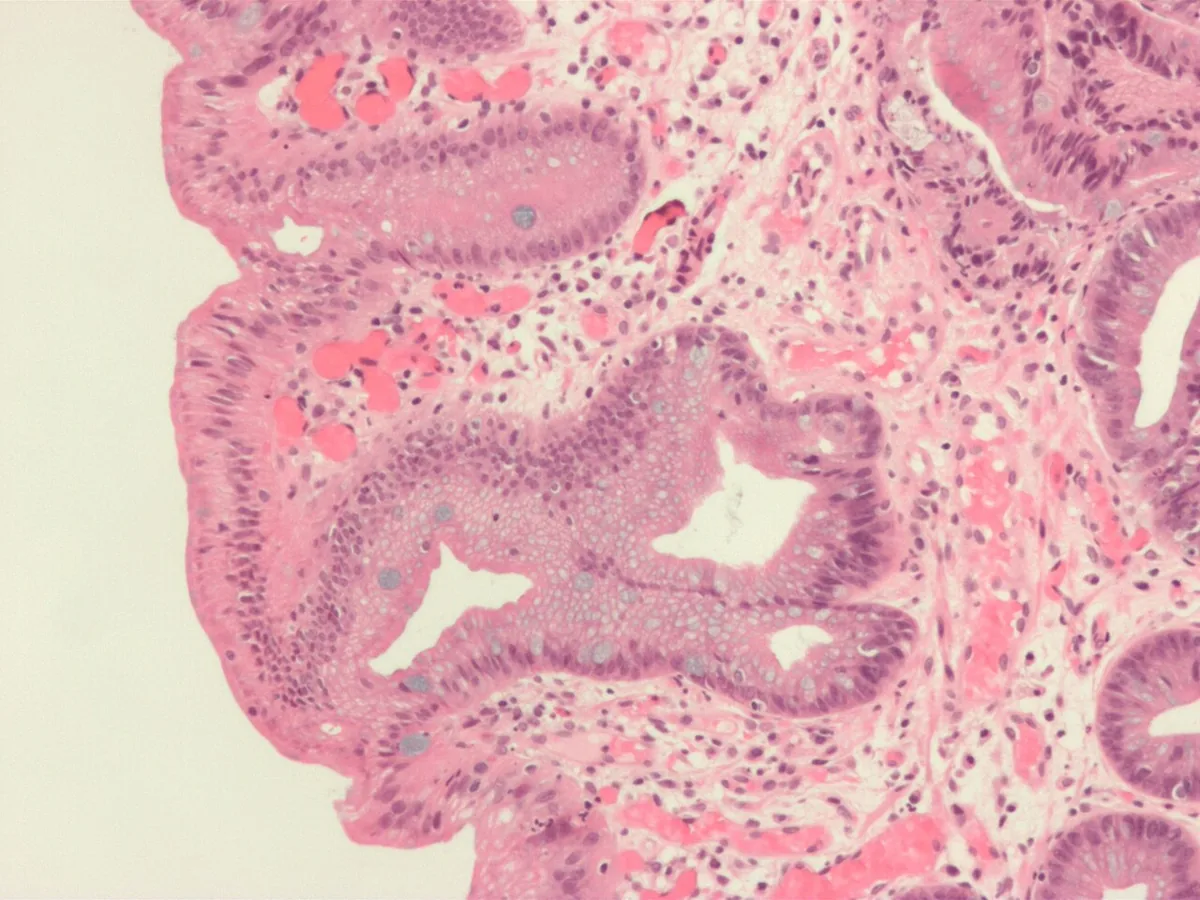 Barrett's esophagus – Histology (Alcian blue stain): columnar metaplasia with blue-staining goblet cells