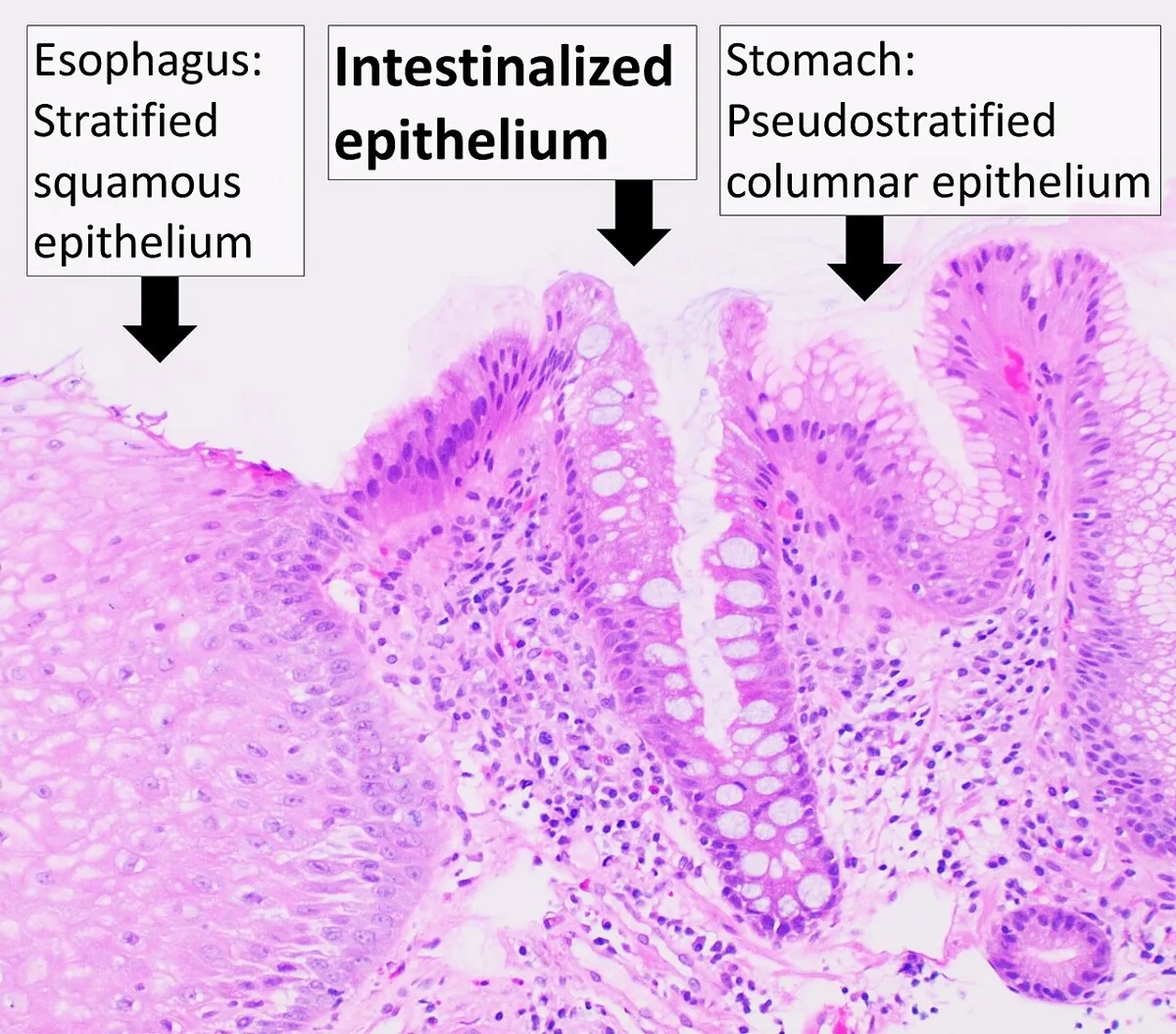 Barrett's esophagus – Histology (H&E, labelled): transition from squamous epithelium to intestinalised columnar epithelium with goblet cells next to gastric mucosa