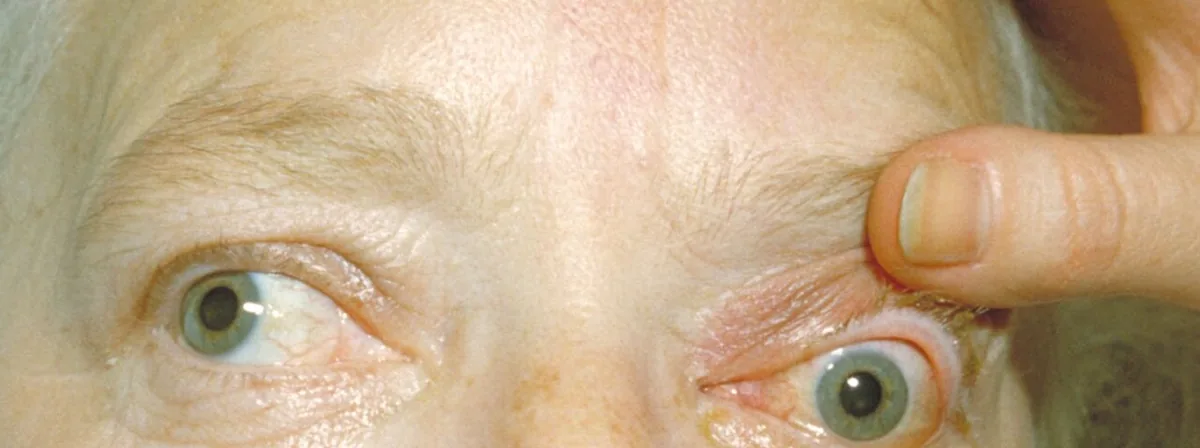 Graves' disease (overactive thyroid) – eyelid – clinical photo: Graves' orbitopathy: bilateral exophthalmos with sclera visible above the cornea and lid retraction