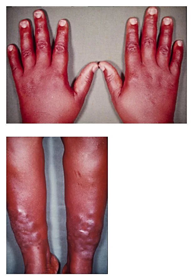 Graves' disease (overactive thyroid) – clinical photo: Pretibial myxedema and acropachy: doughy, reddened swelling of both lower legs and swollen fingers