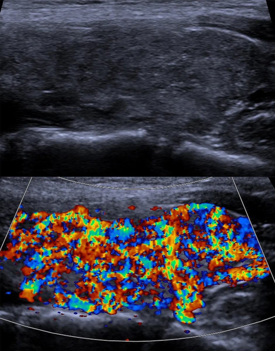 Graves' disease (overactive thyroid) – Thyroid ultrasound in Graves' disease: hypoechoic, heterogeneous parenchyma and markedly increased flow on color Doppler