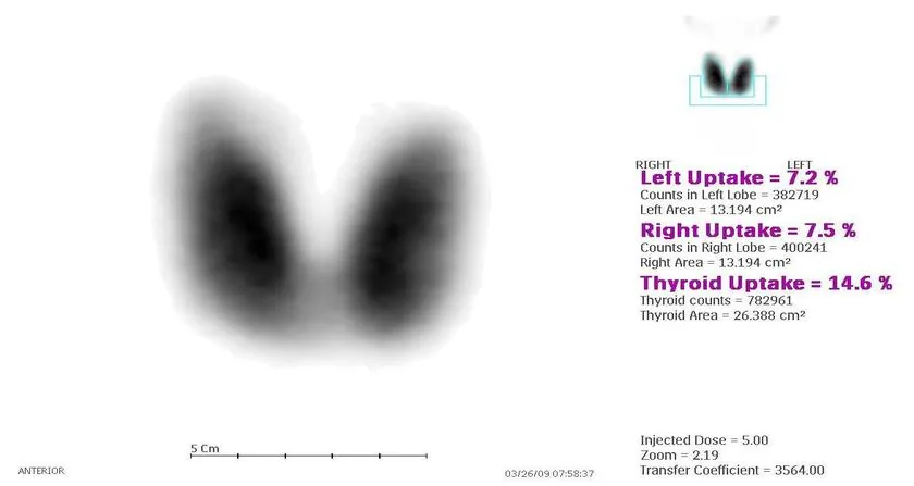 Graves' disease (overactive thyroid) – Thyroid scintigraphy in Graves' disease: diffuse, homogeneous increased tracer uptake in both lobes