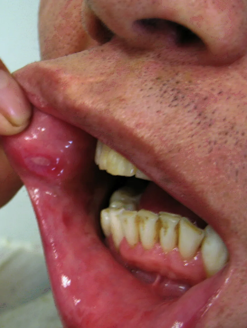Behçet's disease – mouth – clinical photo: Oral ulcer in Behçet's disease: round ulcer with whitish base and red halo on the inner lower lip
