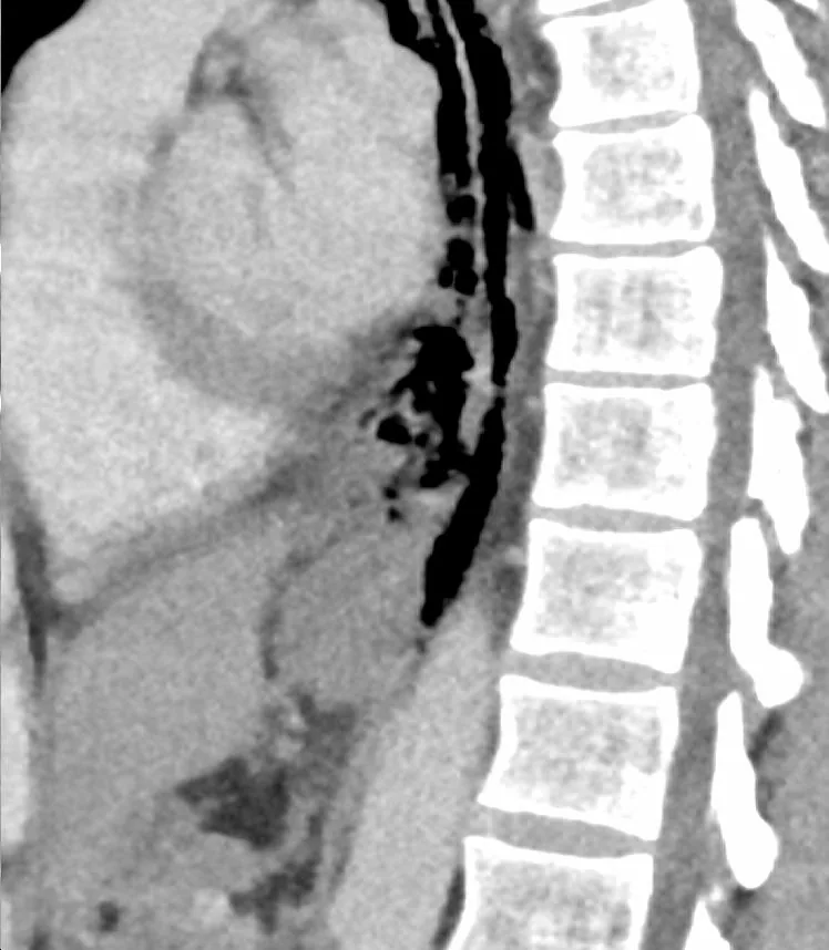 Boerhaave and Mallory-Weiss syndrome – Sagittal CT: wall defect of the distal esophagus with para-esophageal air bubbles
