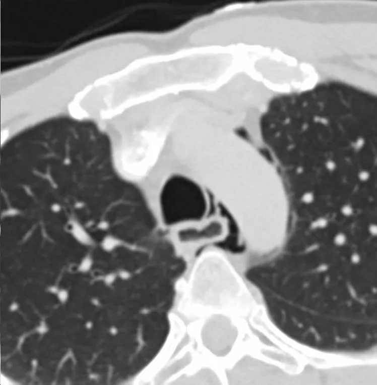 Boerhaave and Mallory-Weiss syndrome – Axial chest CT: free air in the mediastinum around the trachea and esophagus (pneumomediastinum)