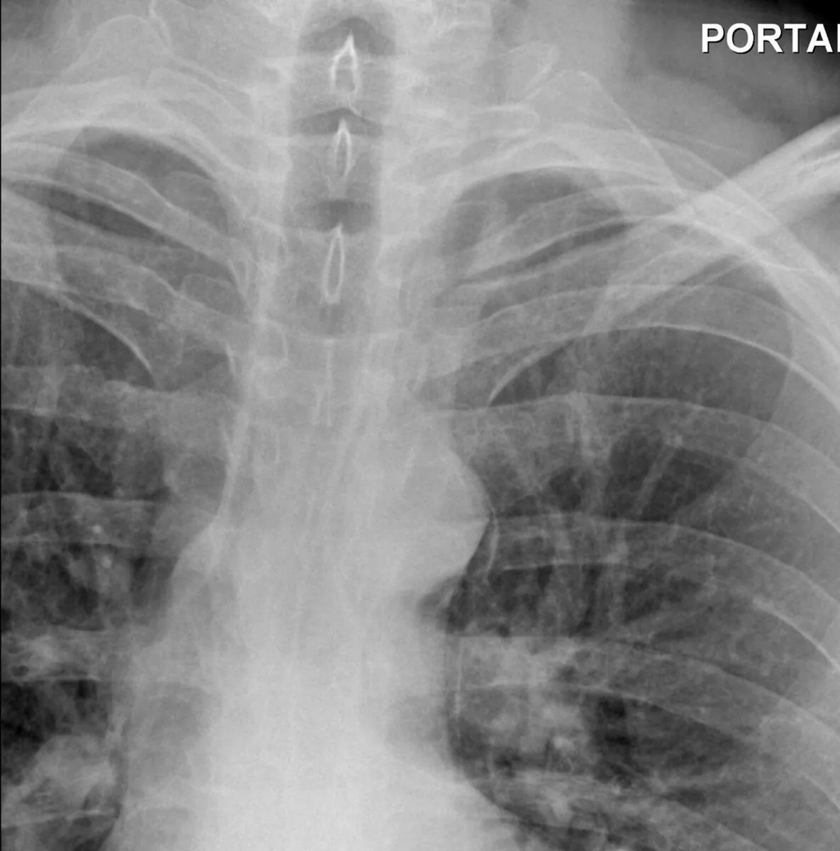 Boerhaave and Mallory-Weiss syndrome – Chest X-ray: air lucency in the mediastinum along the aortic arch and left carotid artery (pneumomediastinum)